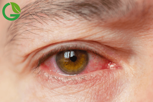 Eye Flu